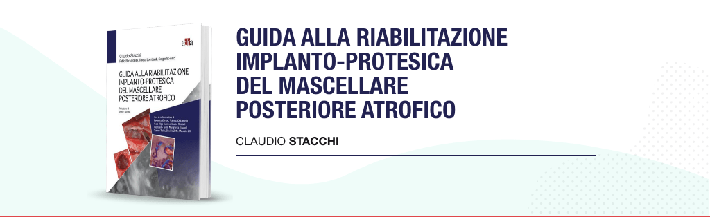 "Guida alla riabilitazione implantoprotesica del mascellare posteriore atrofico" di Claudio Stacchi